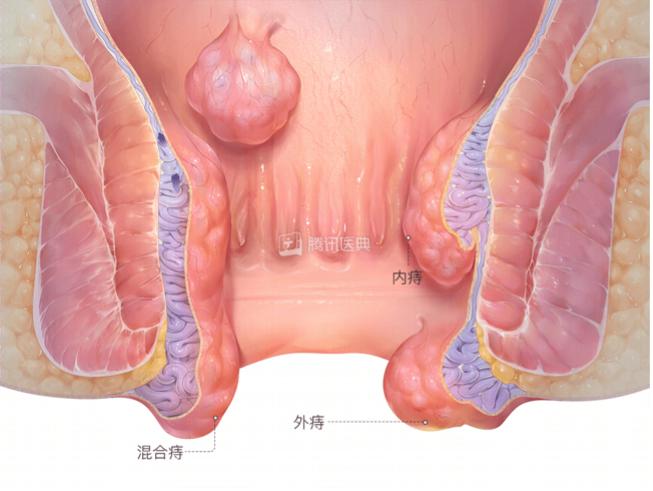 痔疮手术半个月后肛门痒，原因、处理及预防