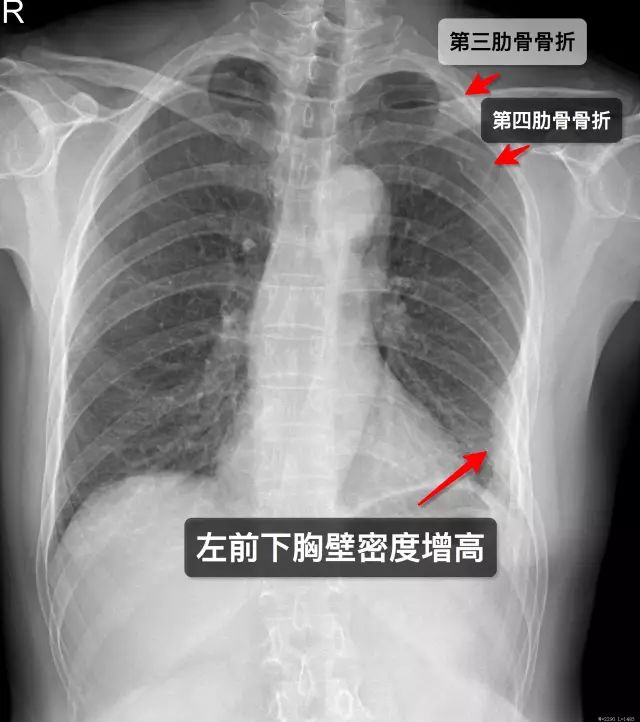 肋骨骨折一个月后错位，恢复、治疗与预防的全方位解析